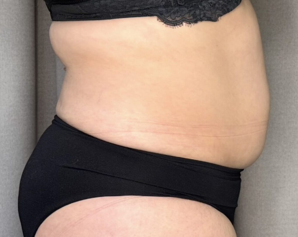 Cryolipolyse resultaat, voor